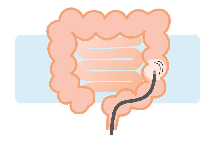 大腸カメラ（下部消化管内視鏡検査）について